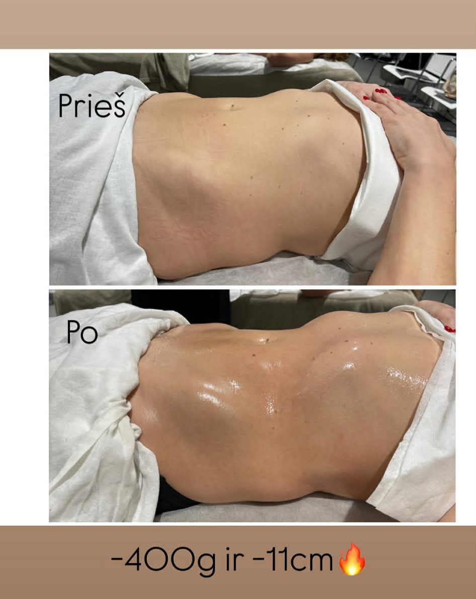 LFF (limfodrenažinis figūrą formuojantis) pilvo masažas