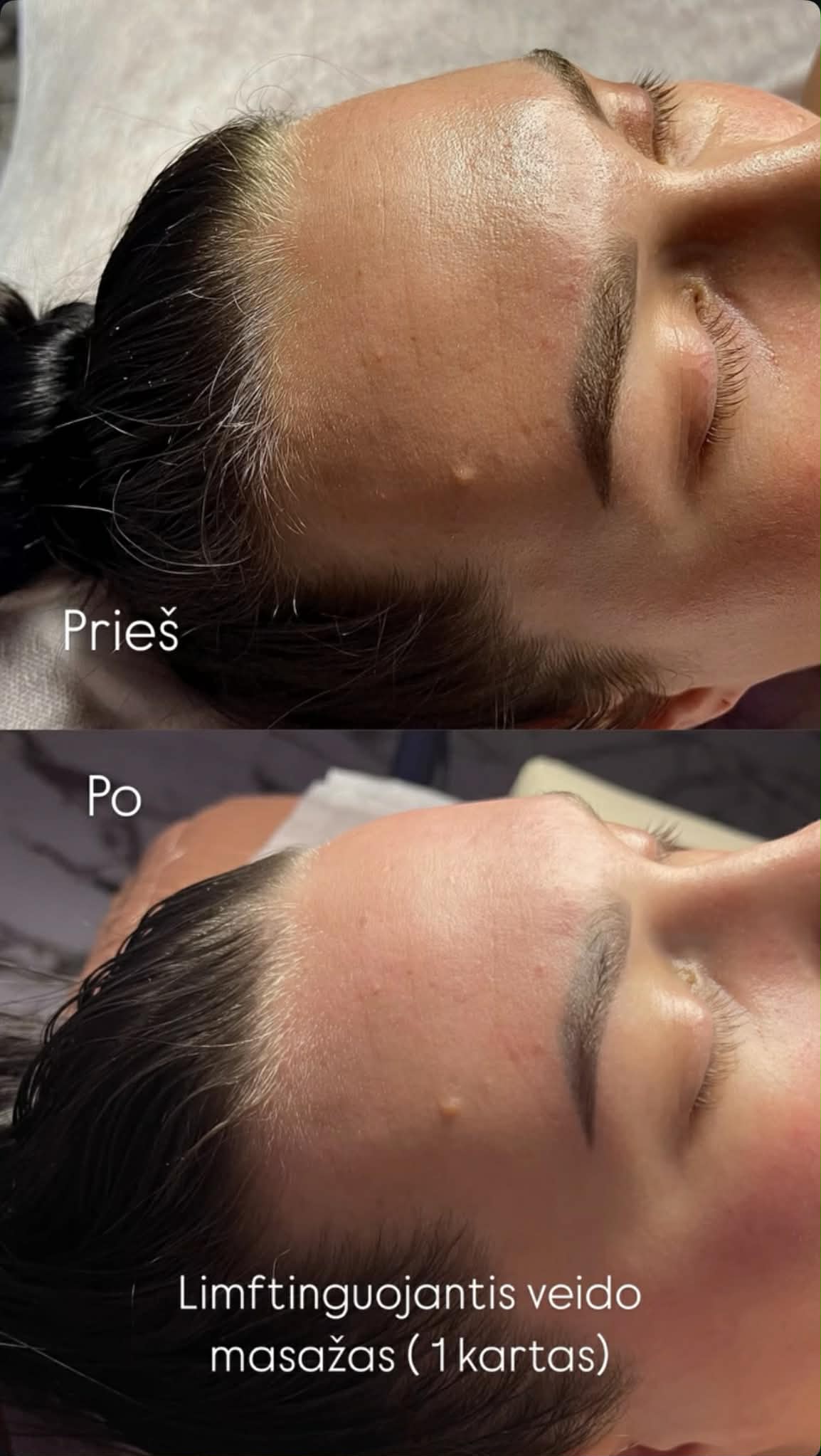 Liftinguojantis veido masažas