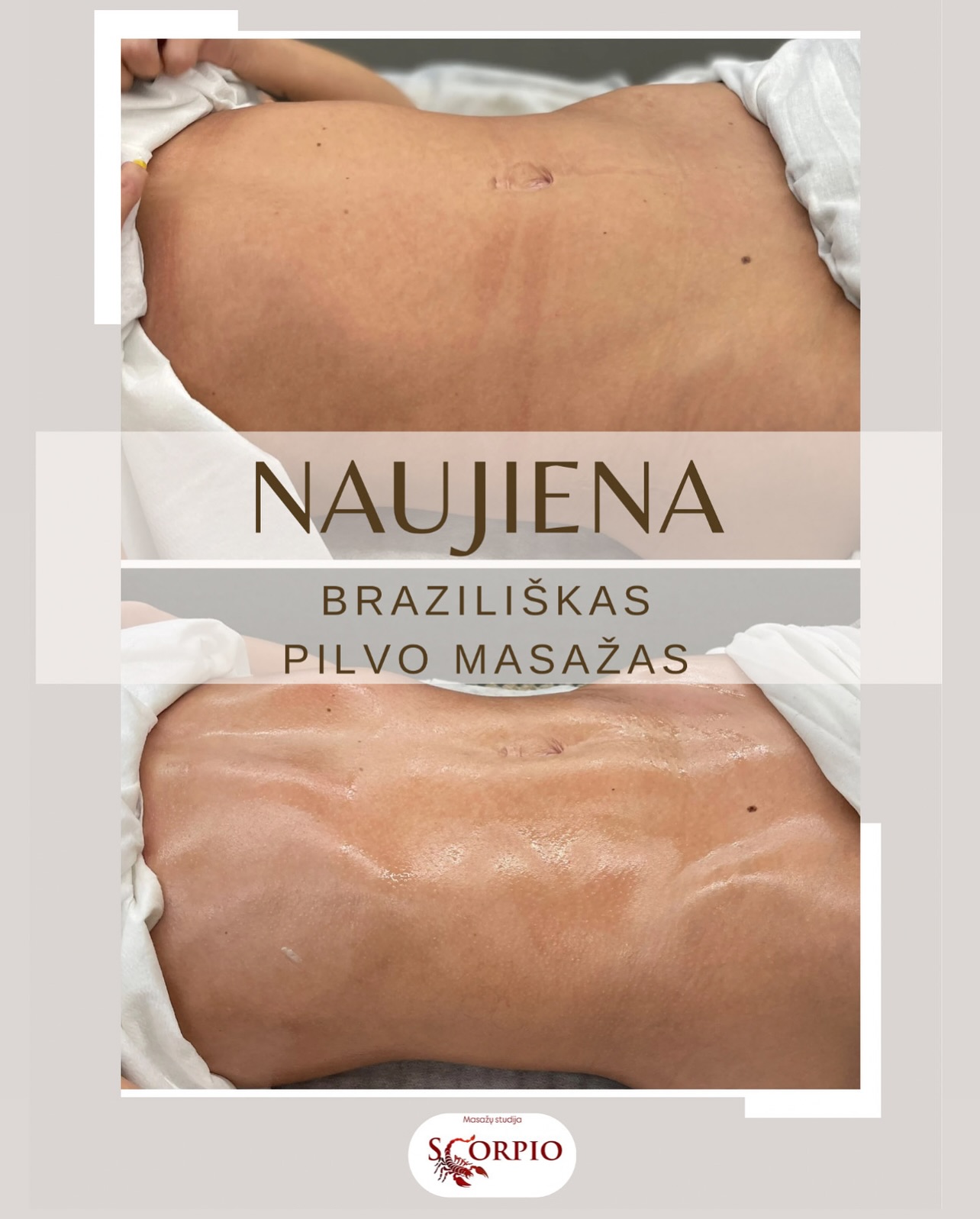 Brazilškas pilvo masažas