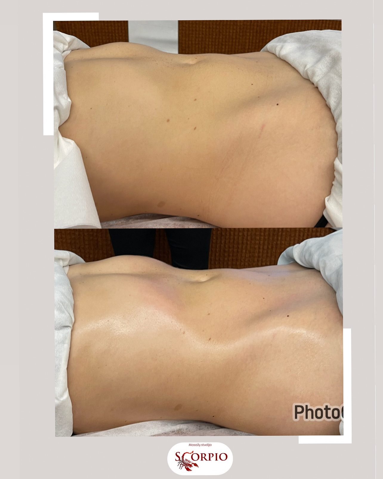 Brazilškas pilvo masažas