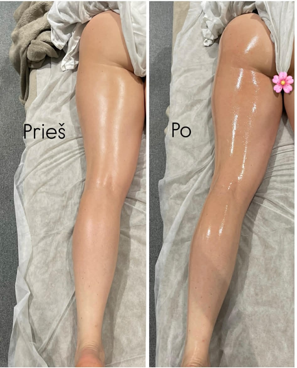 LFF (limfodrenažinis figūrą formuojantis) kojų masažas